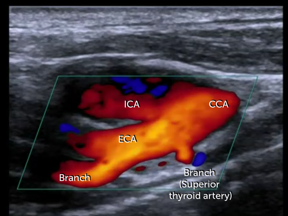 2 Carotid Ultrasound Anatomy 123 Sonography